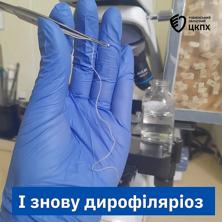 we.ua - На Рівненщині з повіки жінки витягли величезного гельмінта