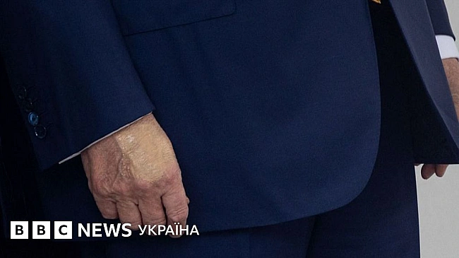 we.ua - Після питань про синці Білий дім оголосив про хворобу Трампа. Що в нього