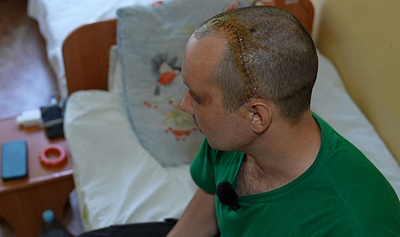 Відновлюють обличчя військовим: у черкаській лікарні почали практикувати новий вид операцій